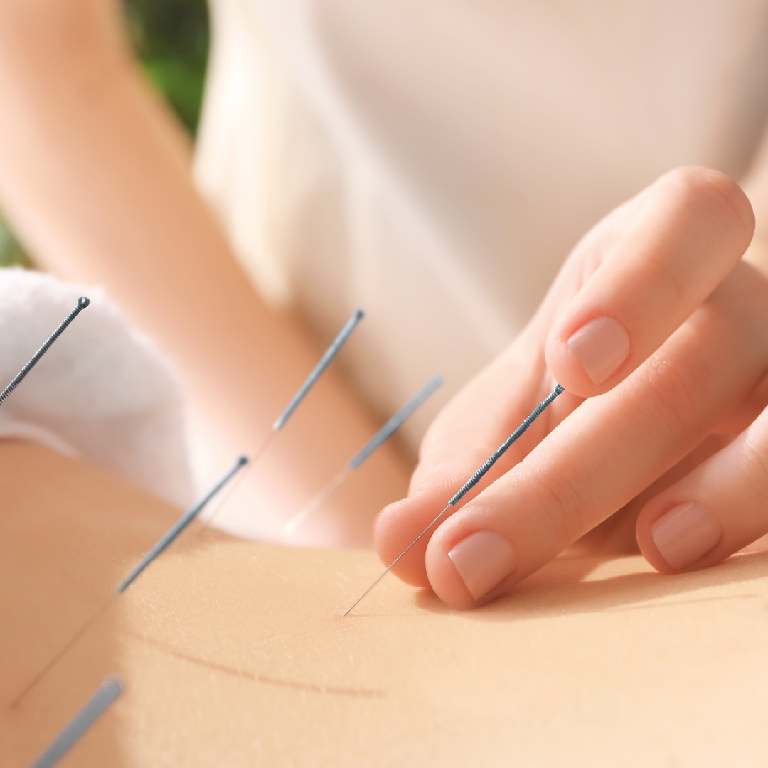 ACUPUNCTURE