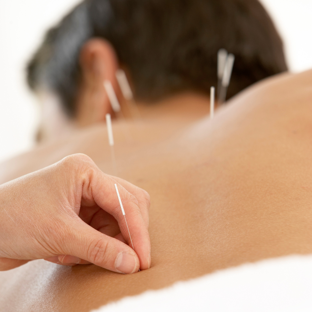 ACUPUNCTURE