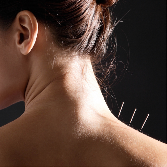 ACUPUNCTURE